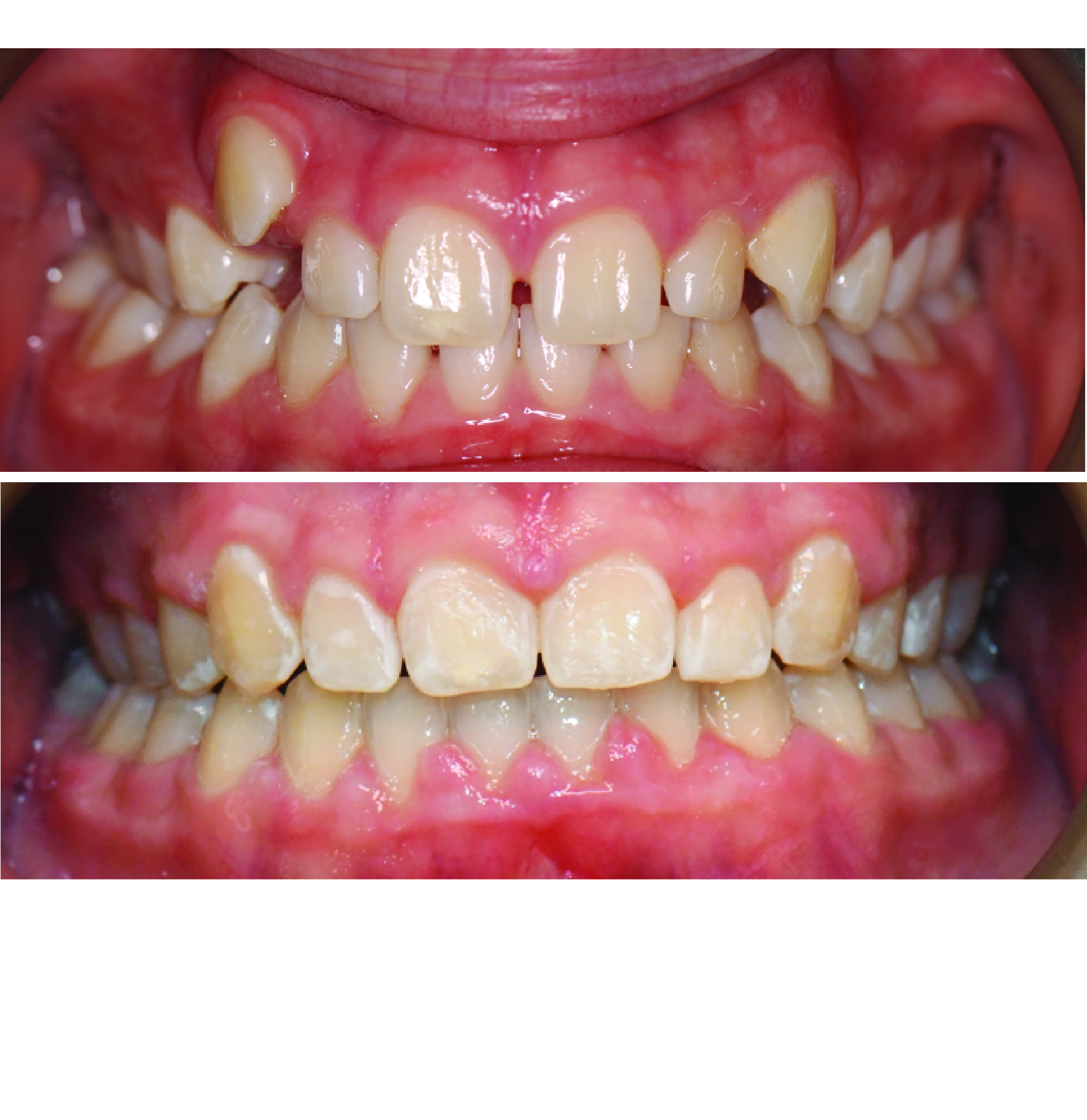 Before-and-after clinical photographs for anonymous case BR-01.