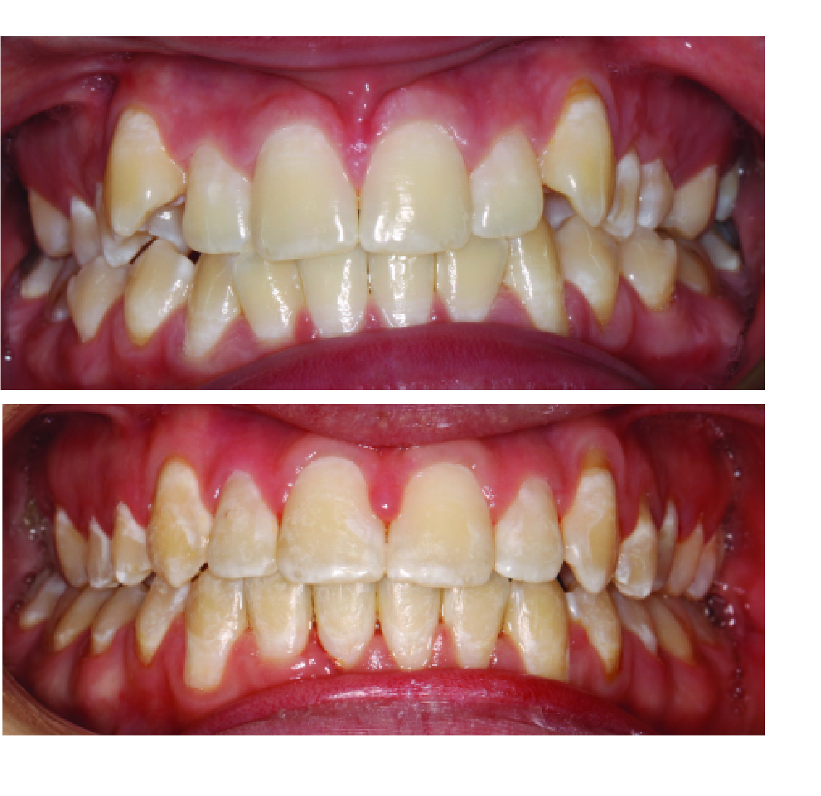 Before-and-after clinical photographs for anonymous case BR-02.