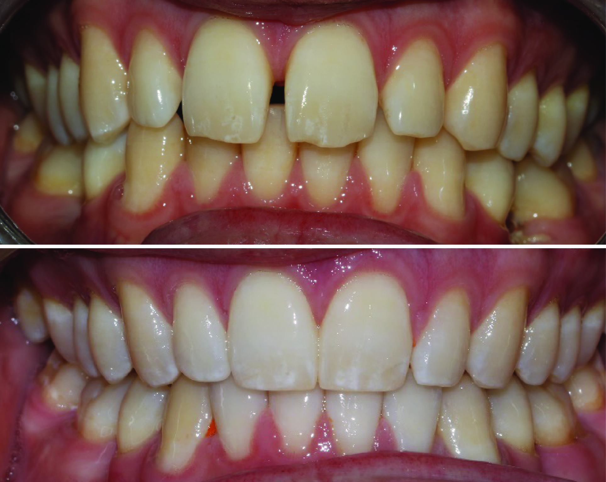 Before-and-after clinical photographs for anonymous case BR-03.