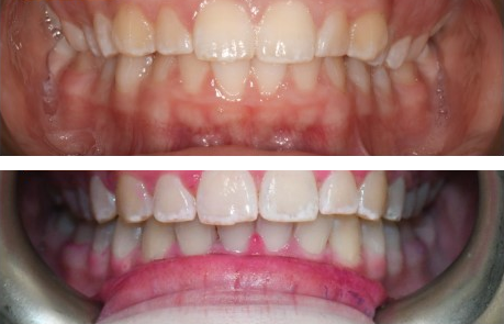 Before-and-after clinical photographs for anonymous case BR-04.