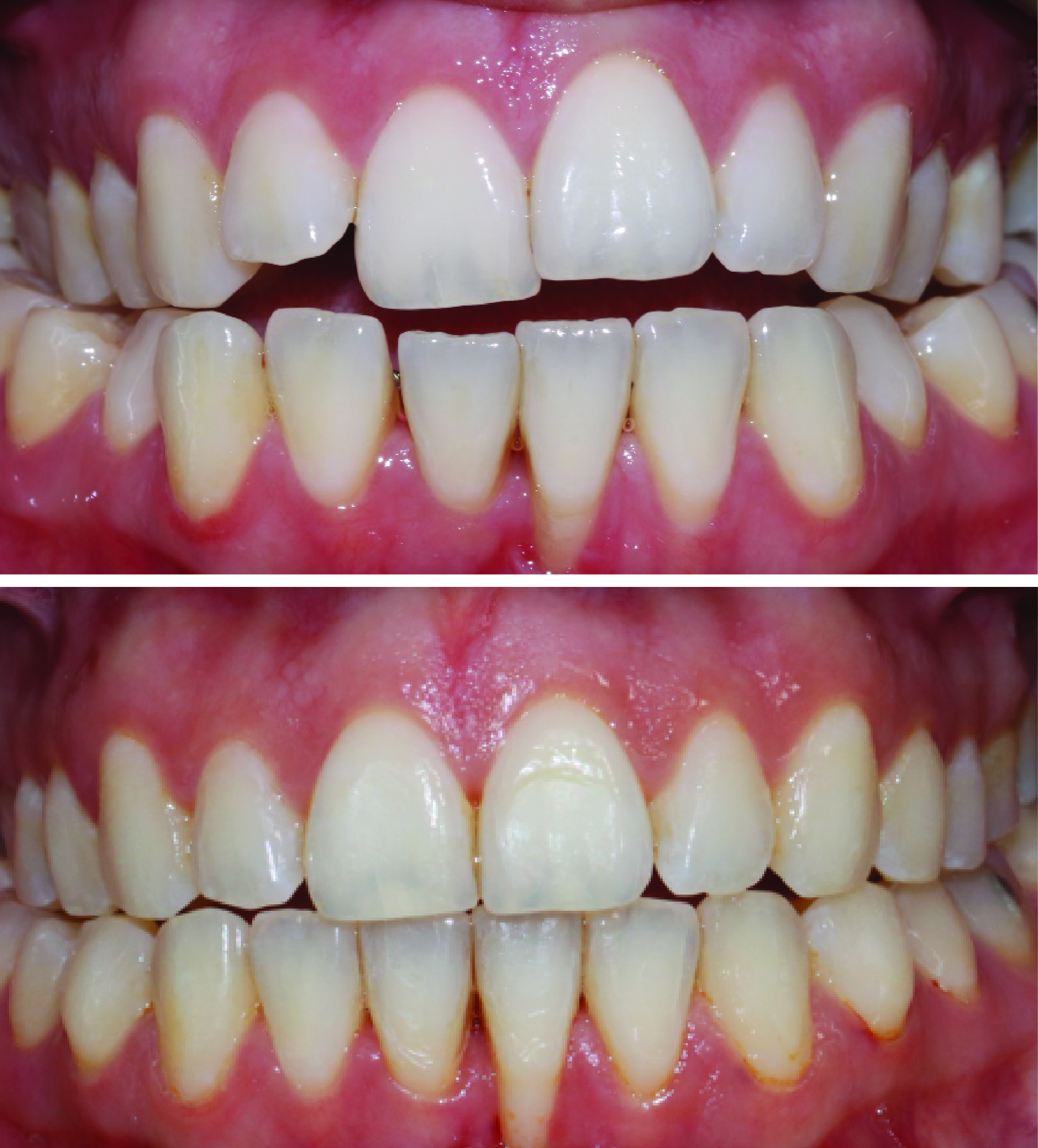 Before-and-after clinical photographs for anonymous case CA-01.