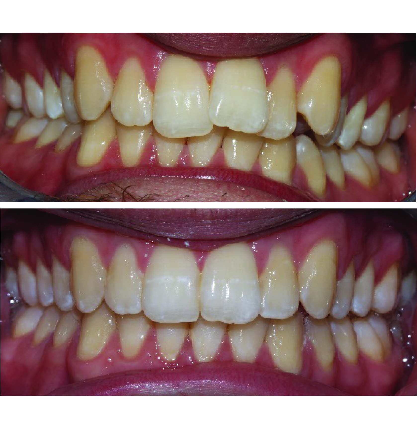 Before-and-after clinical photographs for anonymous case CA-02.
