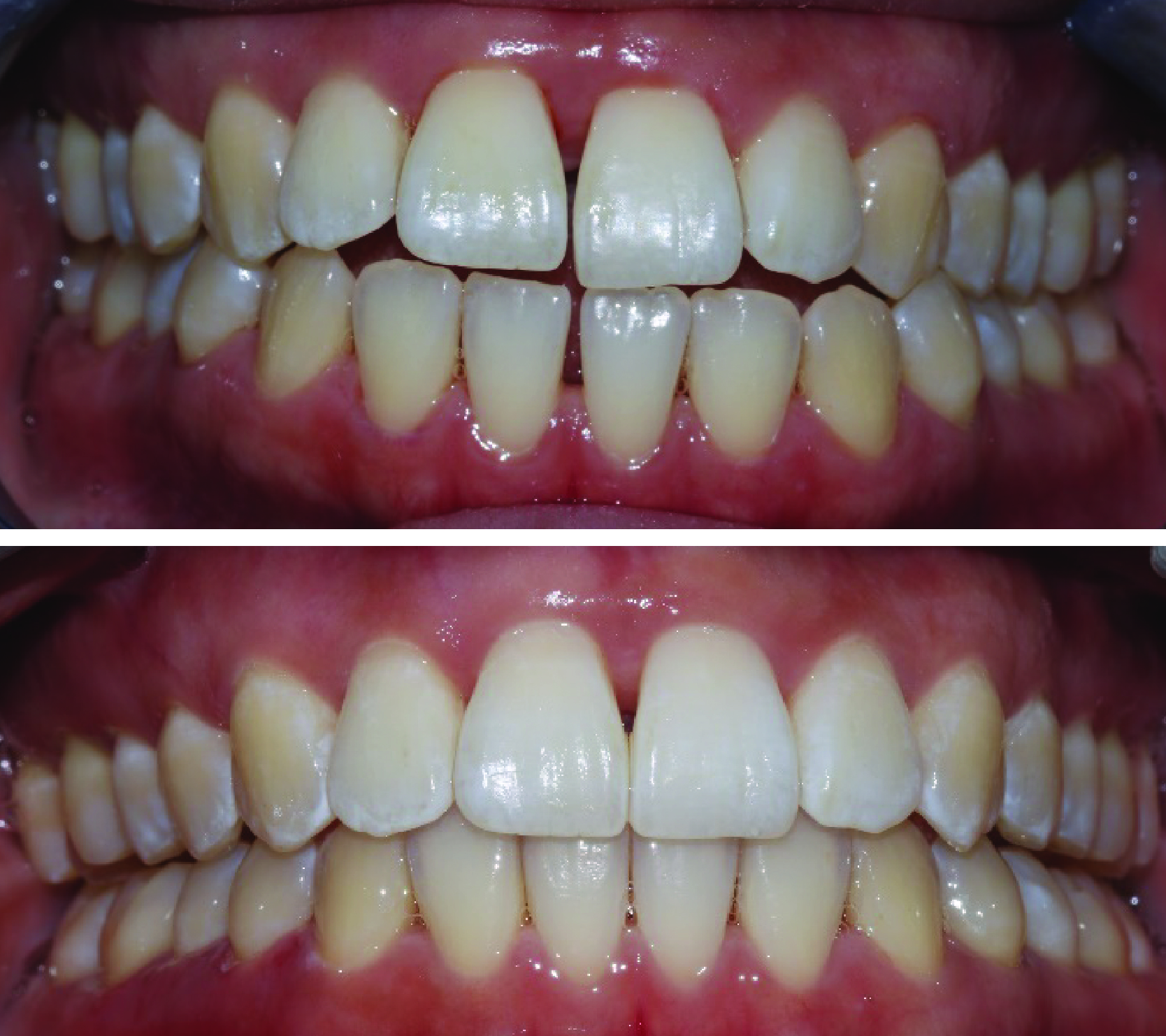 Before-and-after clinical photographs for anonymous case CA-03.