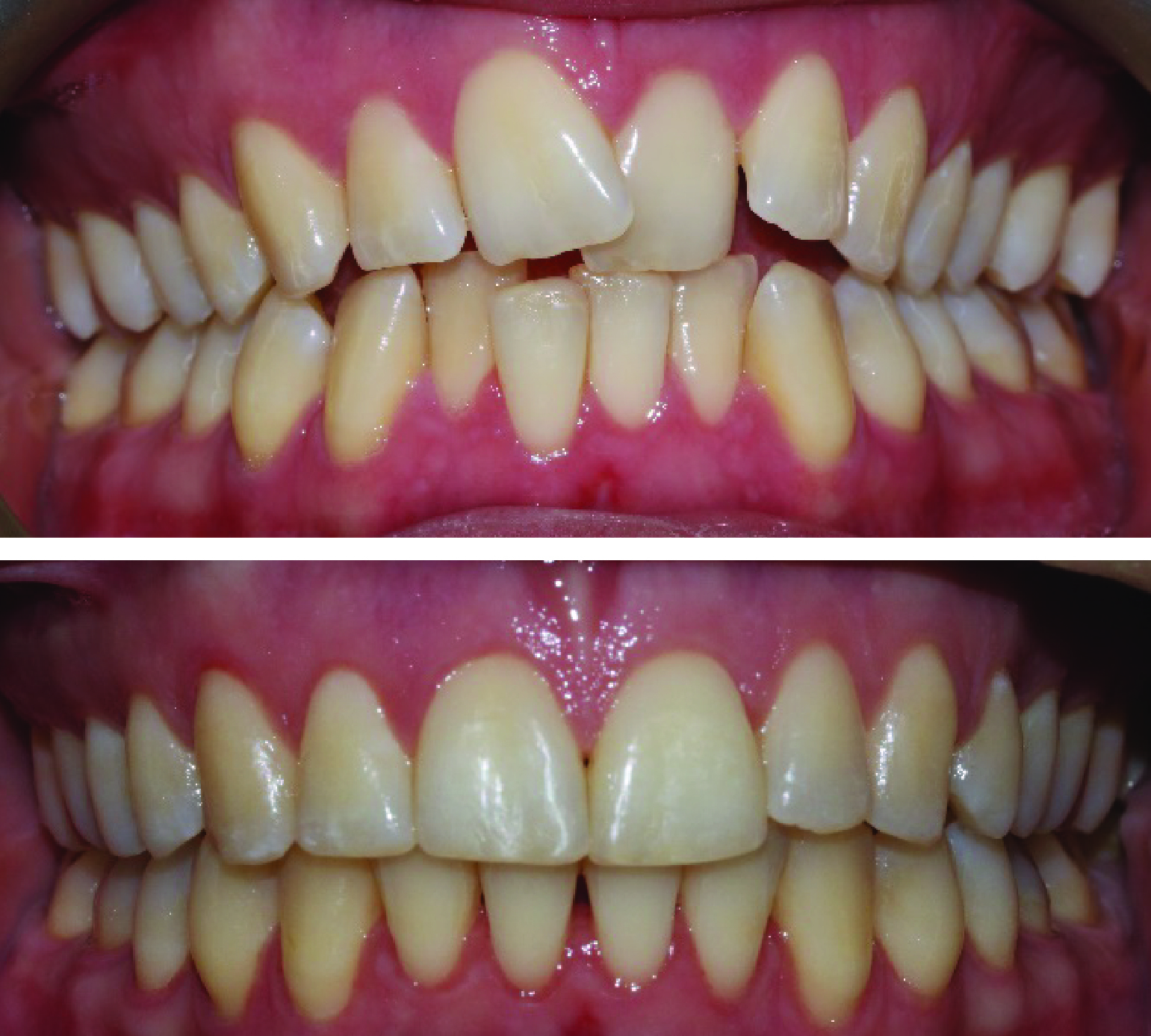 Before-and-after clinical photographs for anonymous case CA-04.