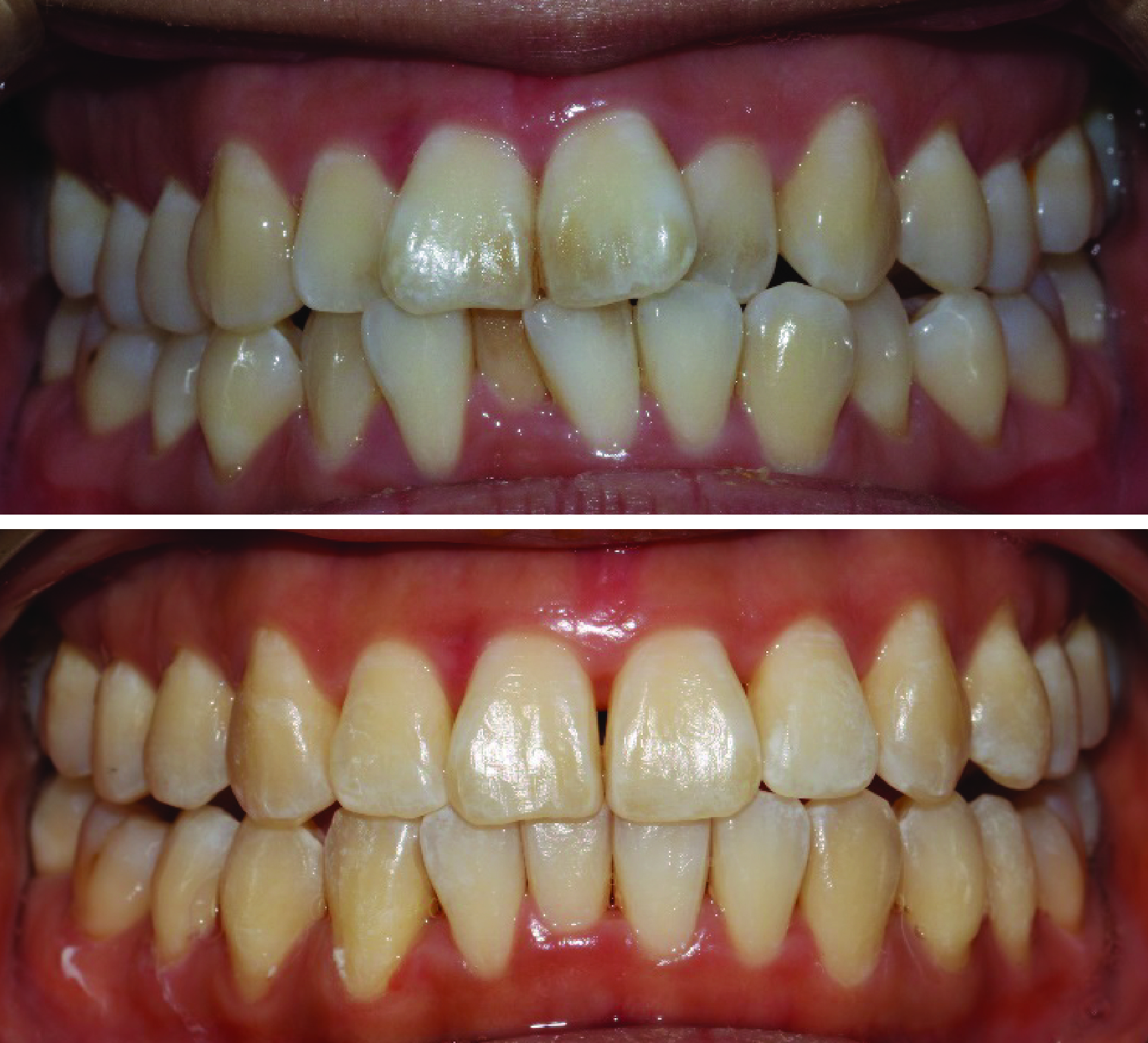 Before-and-after clinical photographs for anonymous case CA-05.
