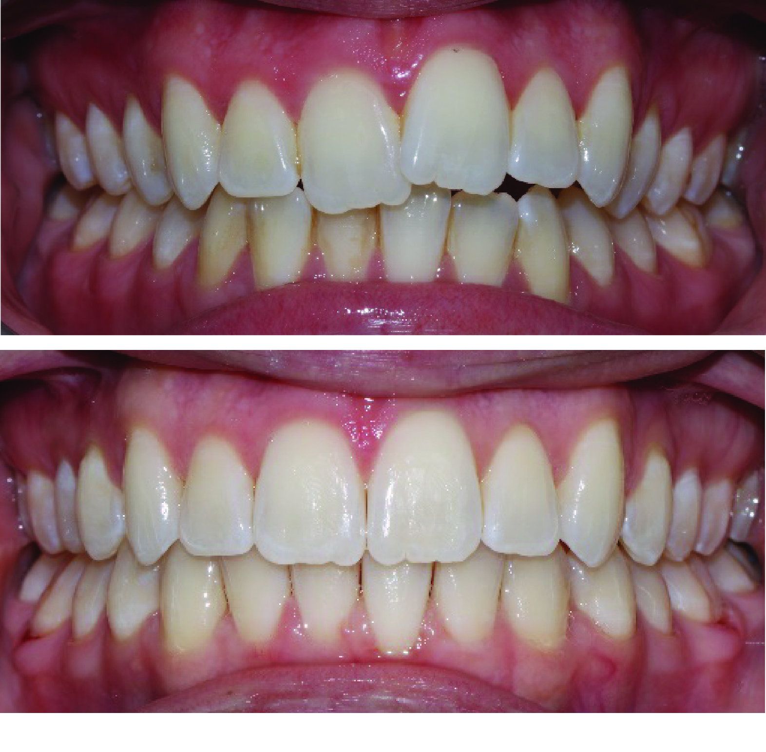 Before-and-after clinical photographs for anonymous case CA-06.