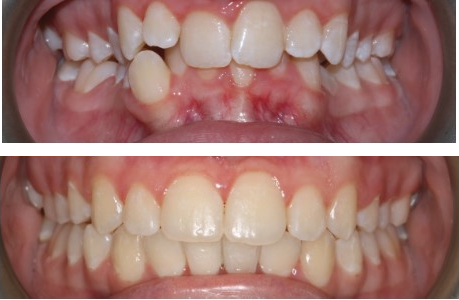 Before-and-after clinical photographs for anonymous case CA-07.