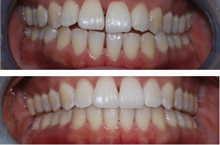 Before-and-after clinical photographs for anonymous case CA-08.