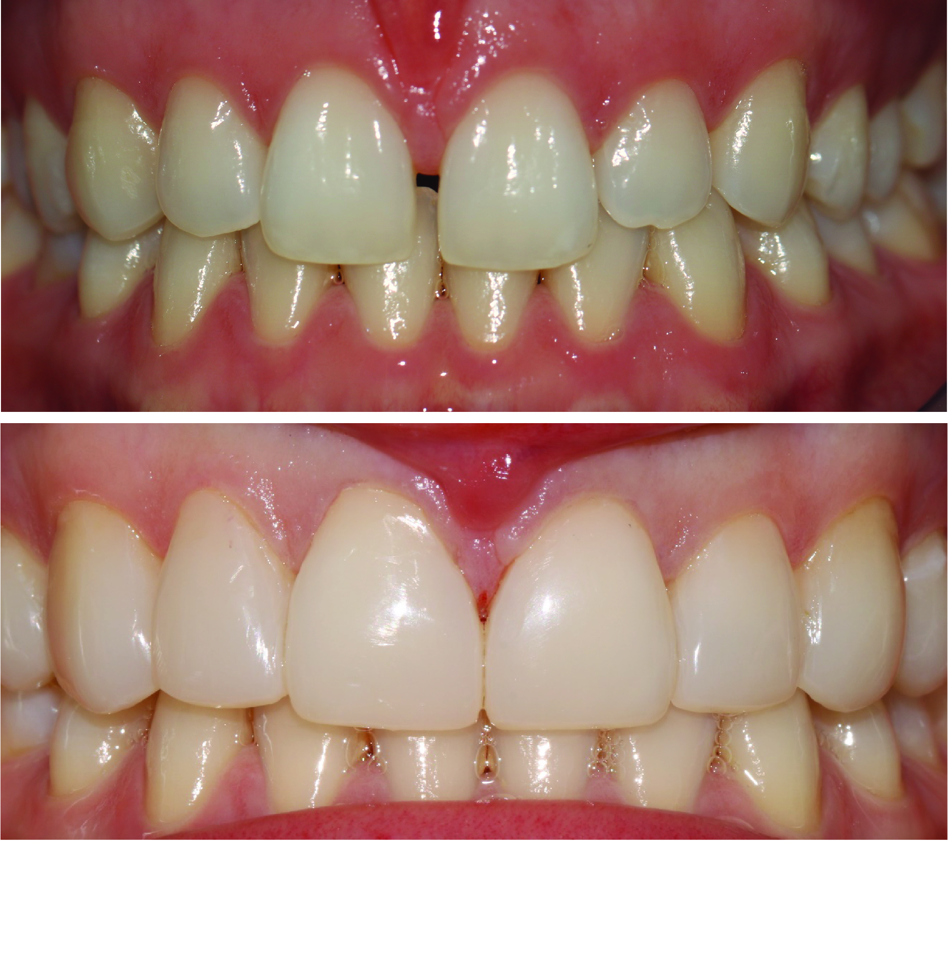 Before-and-after clinical photographs for anonymous case CO-01.