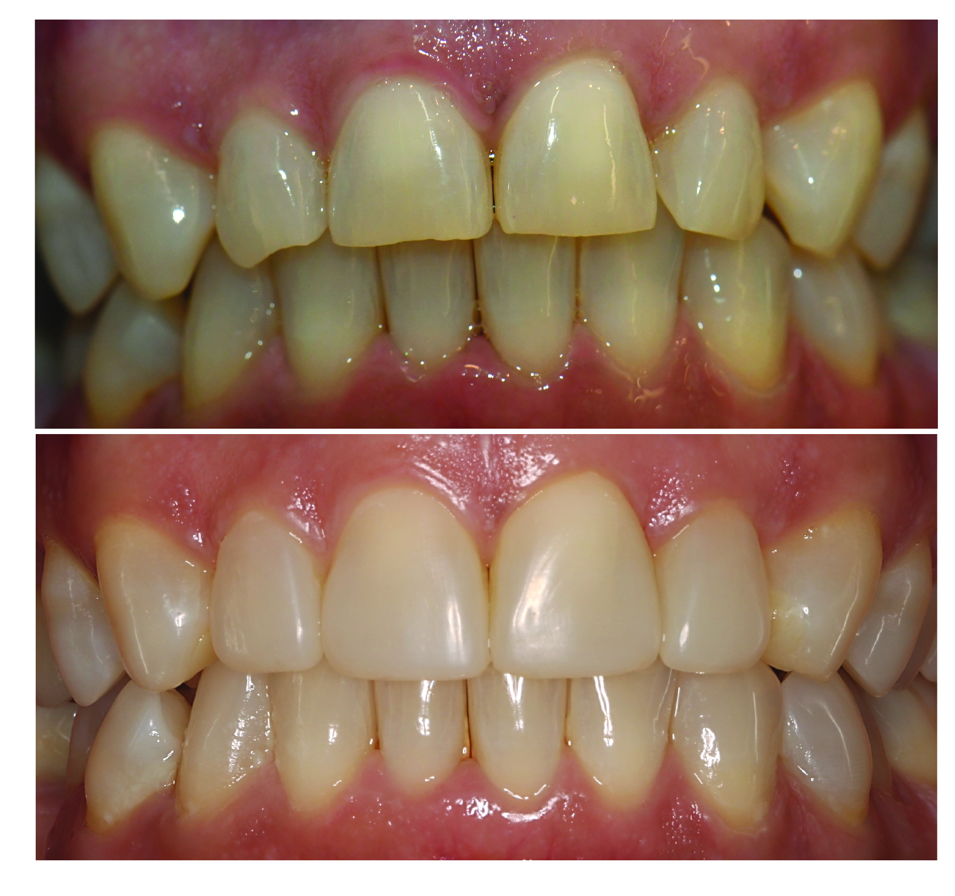 Before-and-after clinical photographs for anonymous case CO-02.