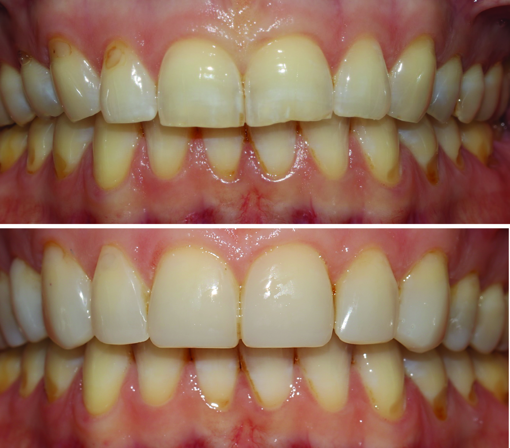 Before-and-after clinical photographs for anonymous case CO-03.
