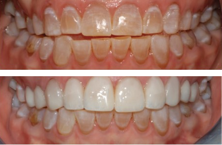 Before-and-after clinical photographs for anonymous case CO-05.