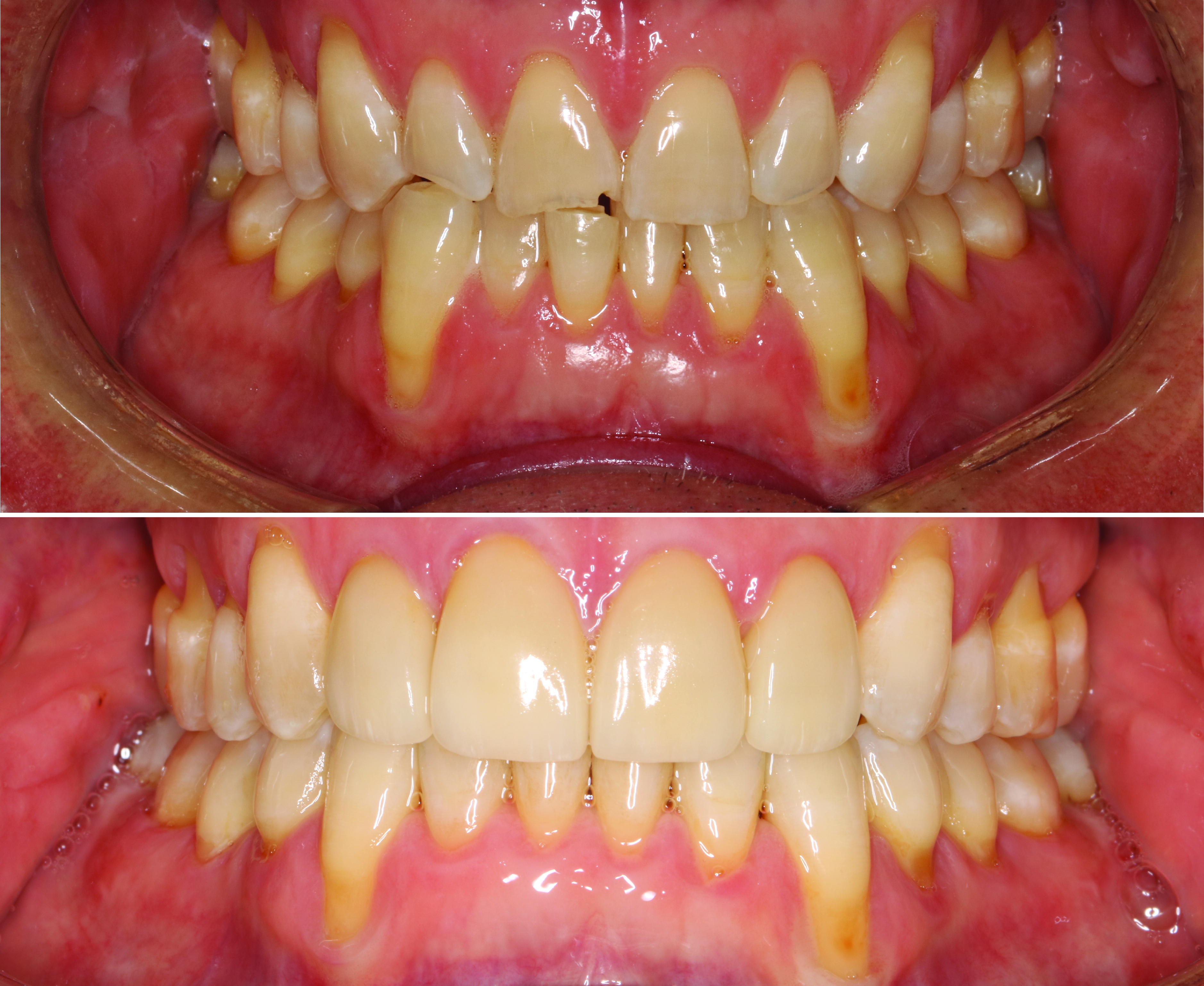 Before-and-after clinical photographs for anonymous case CO-06.