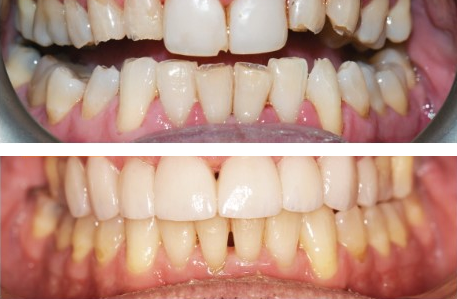 Before-and-after clinical photographs for anonymous case CO-07.