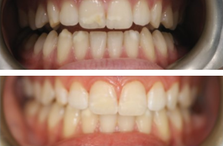 Before-and-after clinical photographs for anonymous case CO-09.