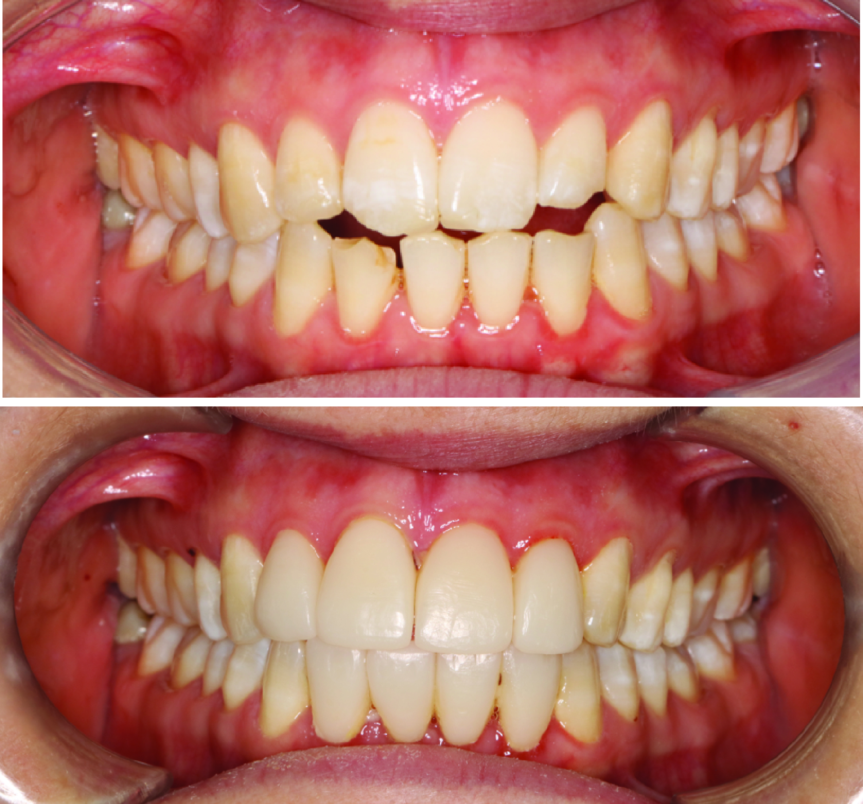 Before-and-after clinical photographs for anonymous case CO-10.