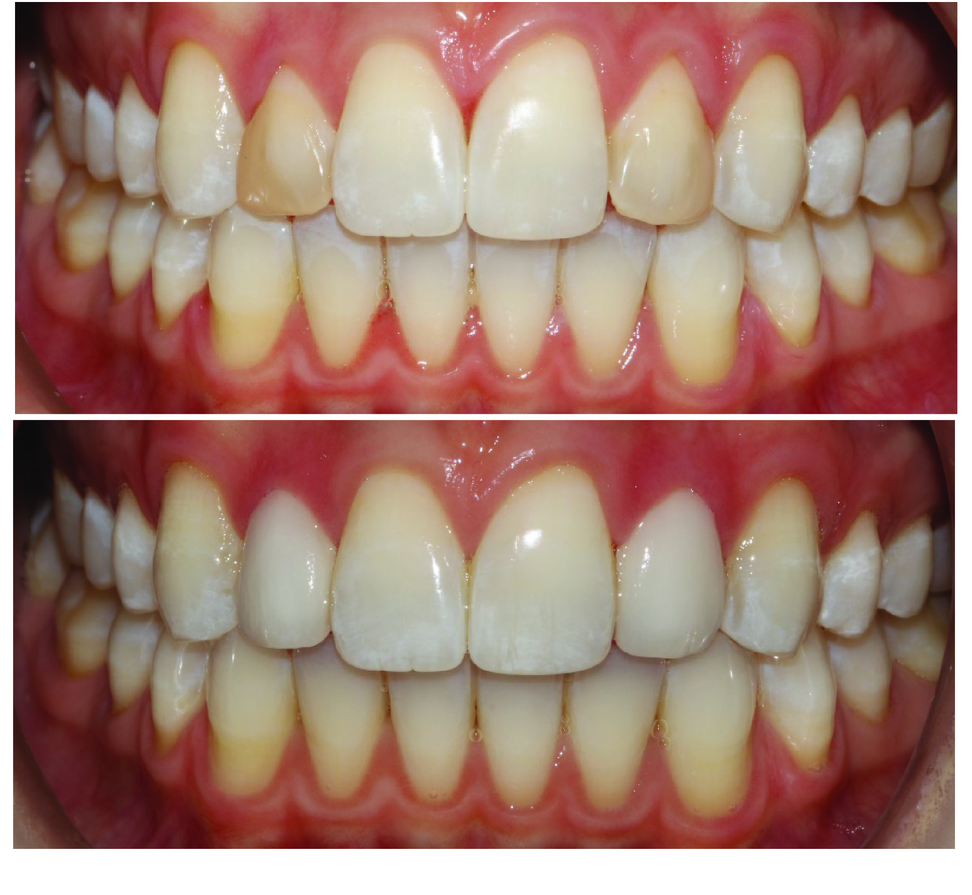 Before-and-after clinical photographs for anonymous case CO-11.