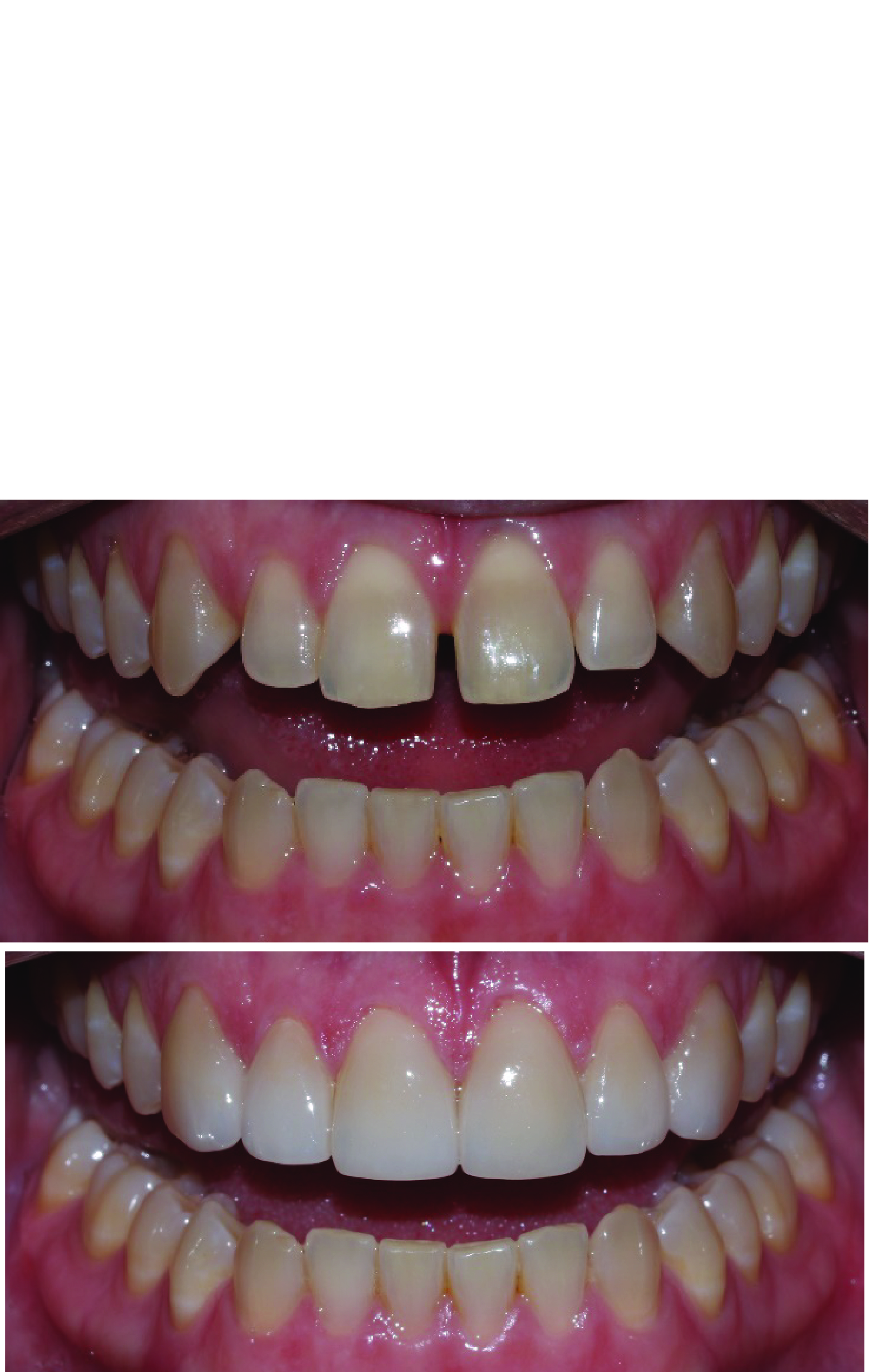 Before-and-after clinical photographs for anonymous case CO-12.