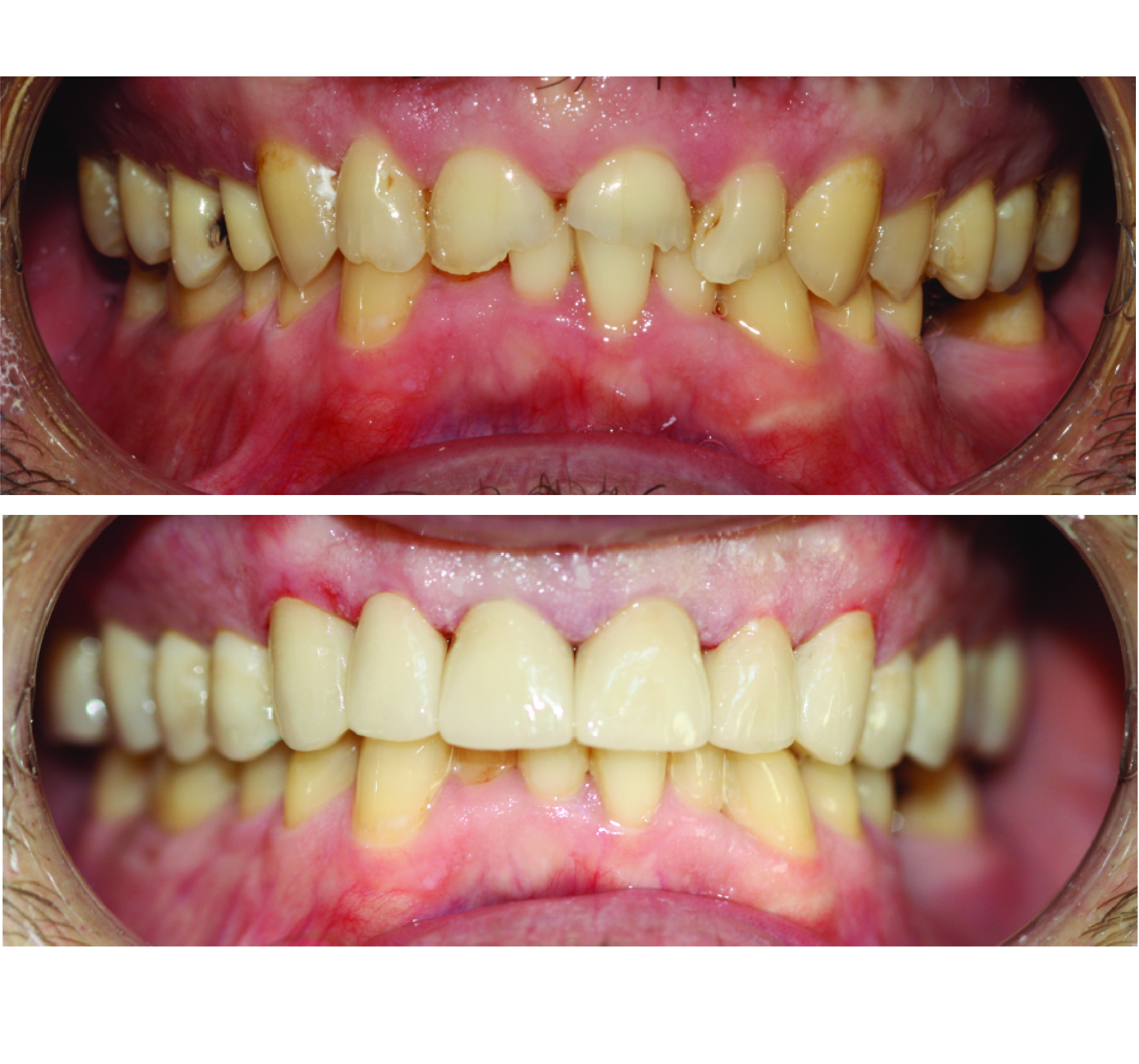 Before-and-after clinical photographs for anonymous case CO-13.