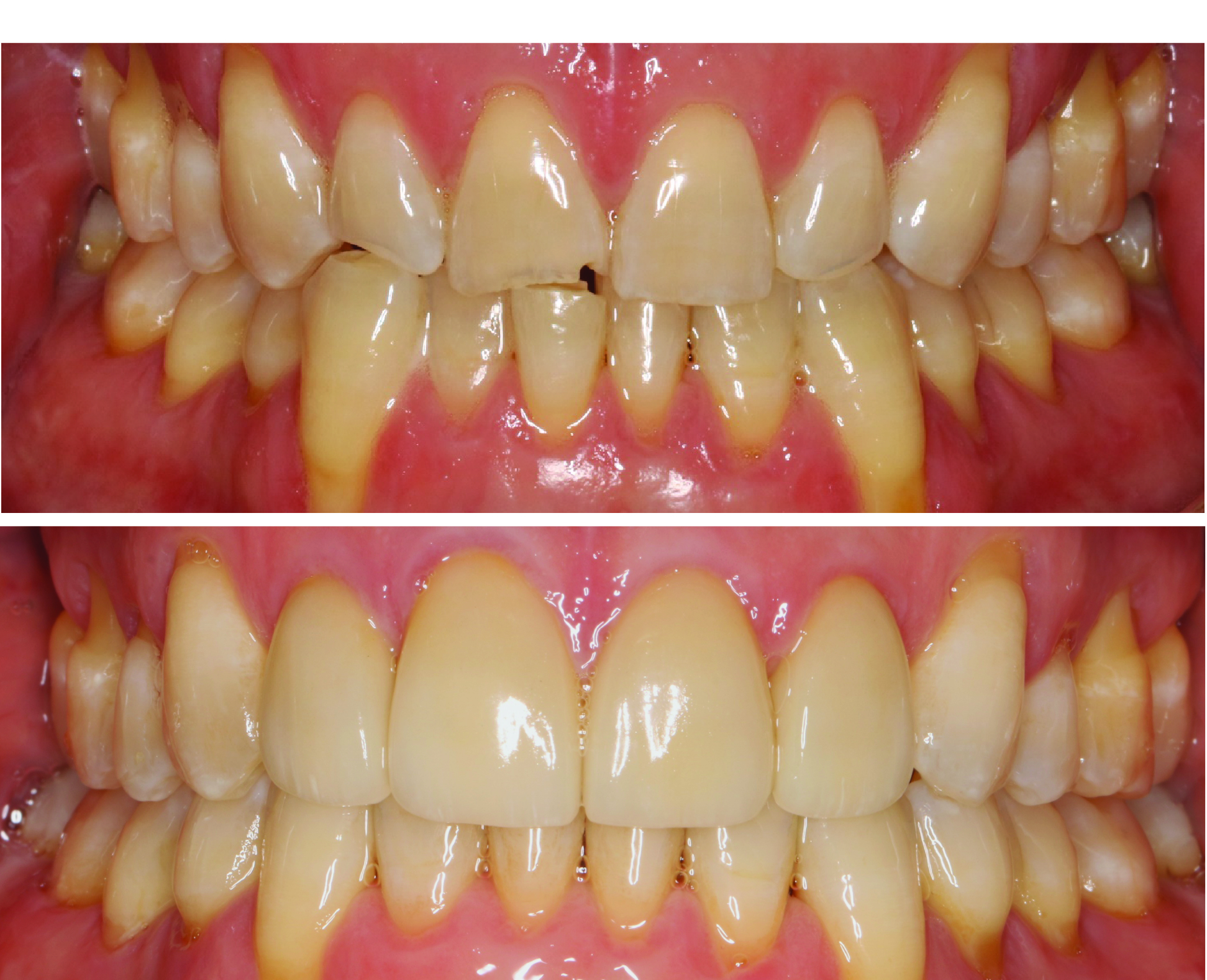 Before-and-after clinical photographs for anonymous case OPV-01.