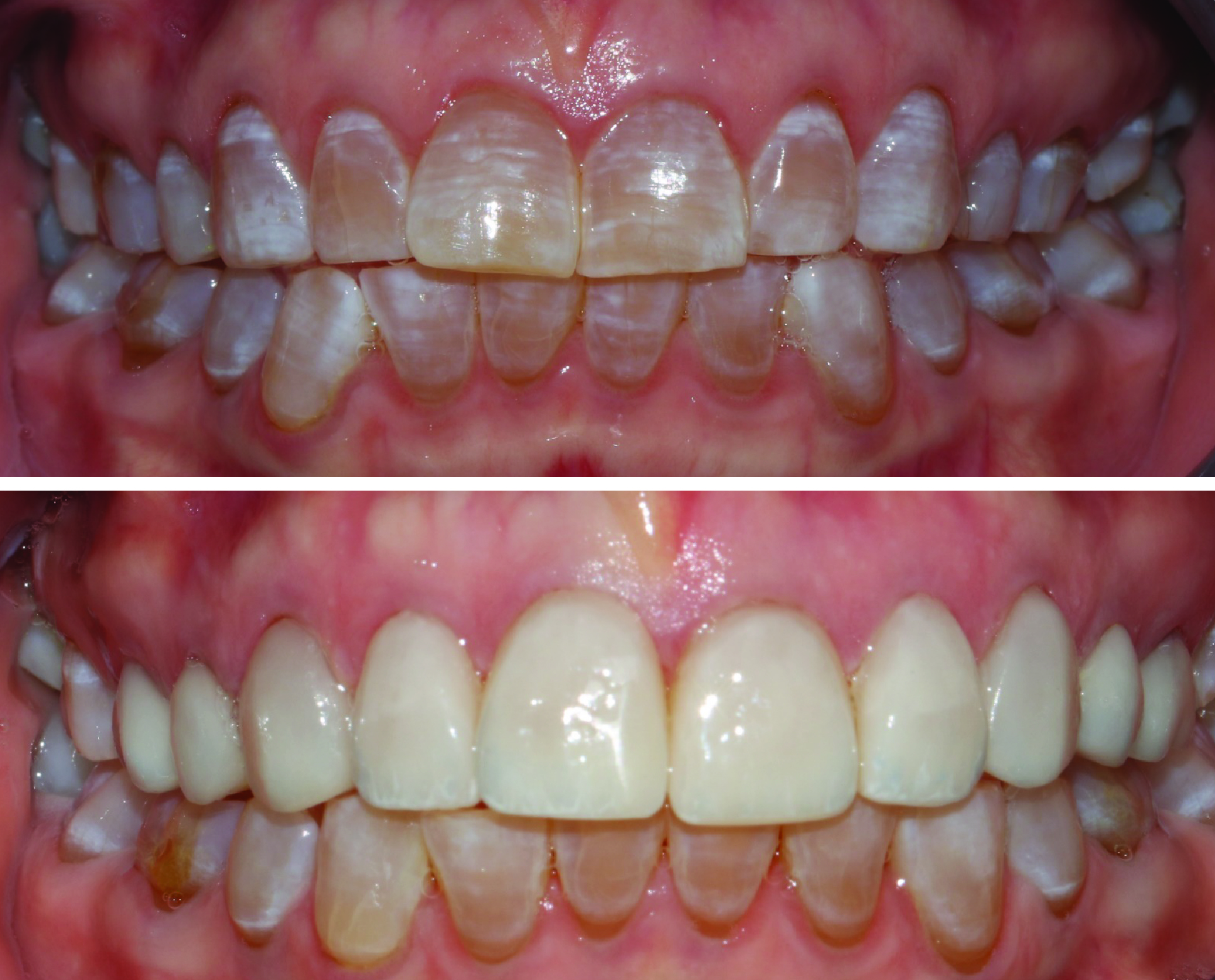 Before-and-after clinical photographs for anonymous case OPV-02.