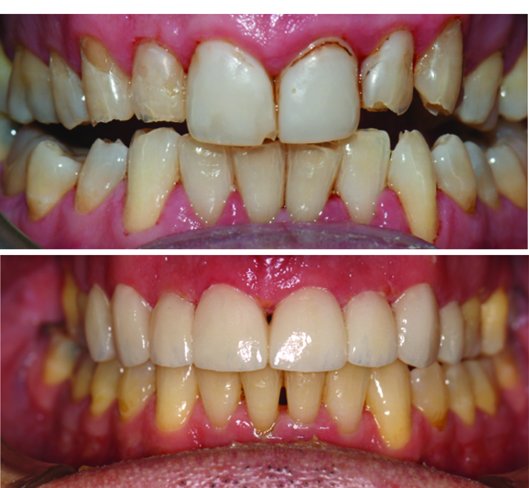 Before-and-after clinical photographs for anonymous case OPV-03.