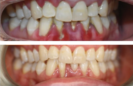 Before-and-after clinical photographs for anonymous case PT-01.