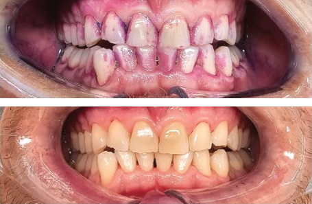 Before-and-after clinical photographs for anonymous case PT-02.