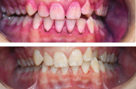 Before-and-after clinical photographs for anonymous case PT-03.