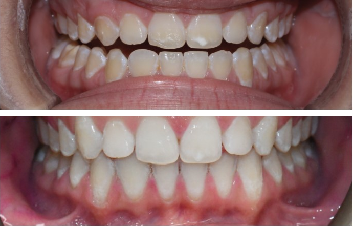 Before-and-after clinical photographs for anonymous case ZI-01.