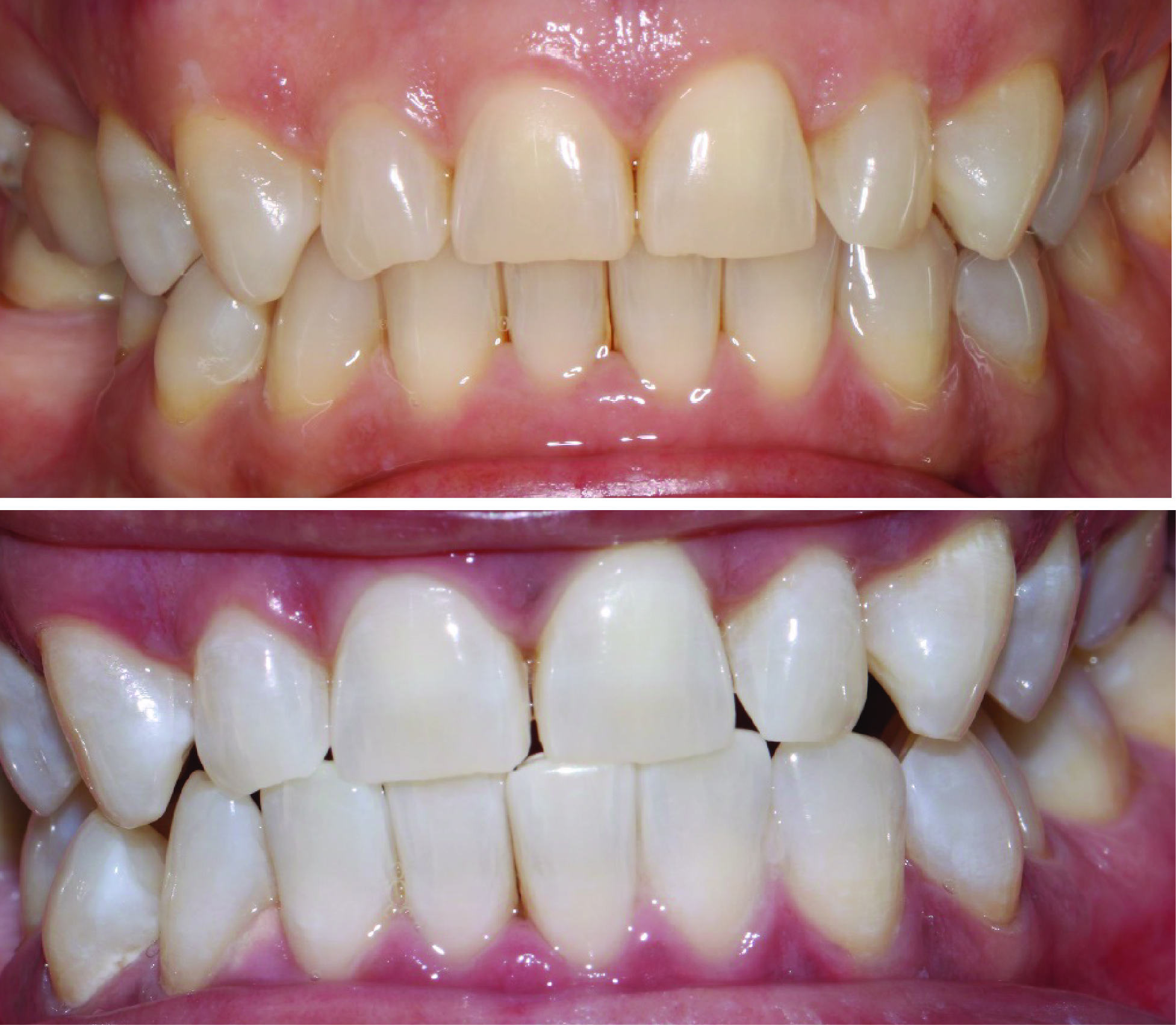 Before-and-after clinical photographs for anonymous case ZW-01.