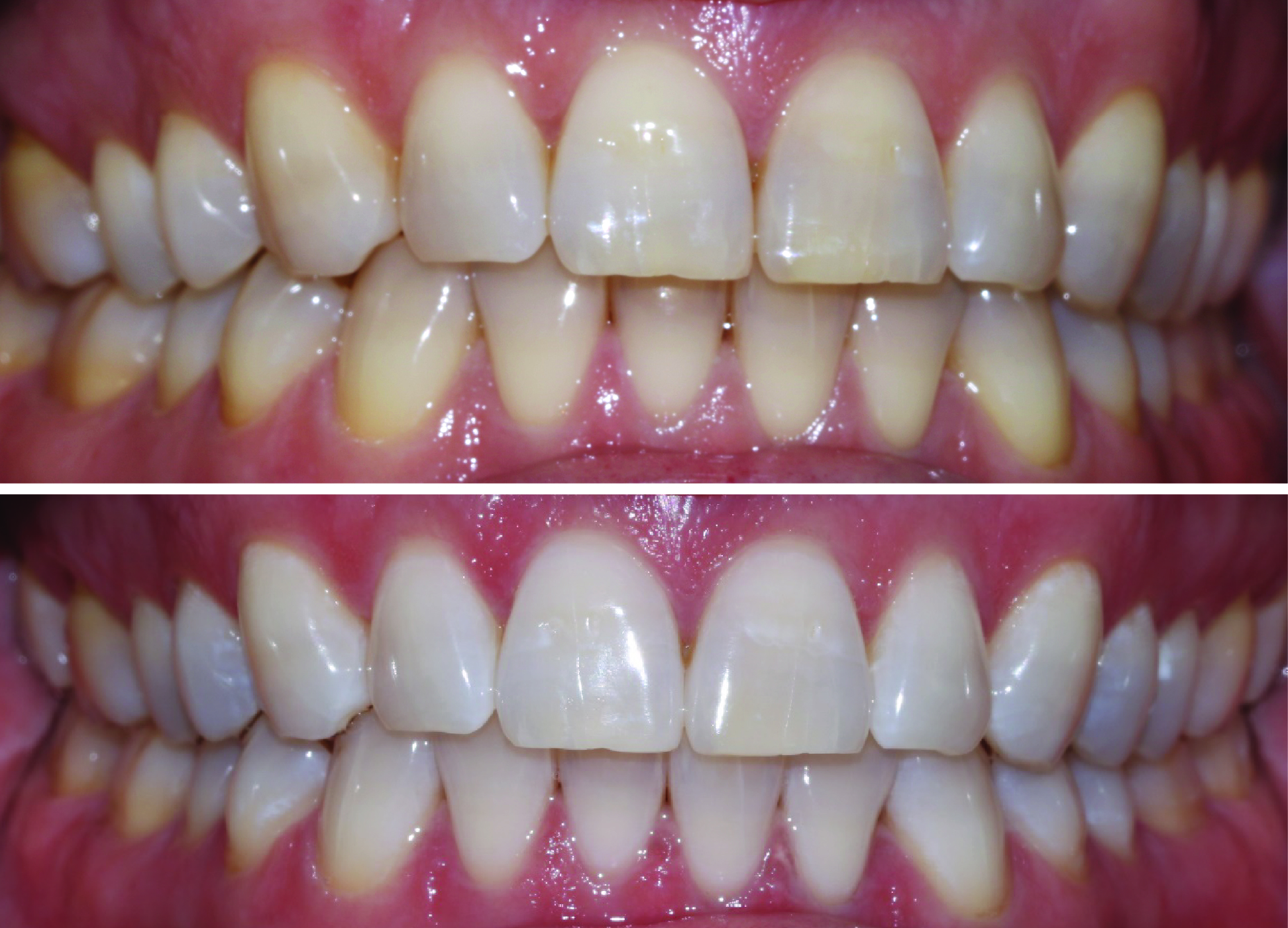 Before-and-after clinical photographs for anonymous case ZW-02.