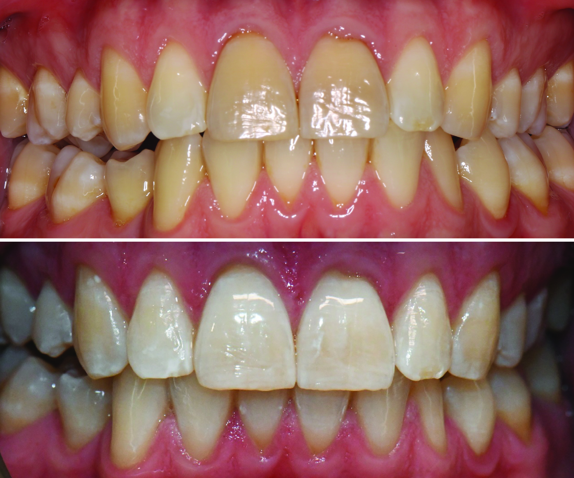 Before-and-after clinical photographs for anonymous case ZW-03.
