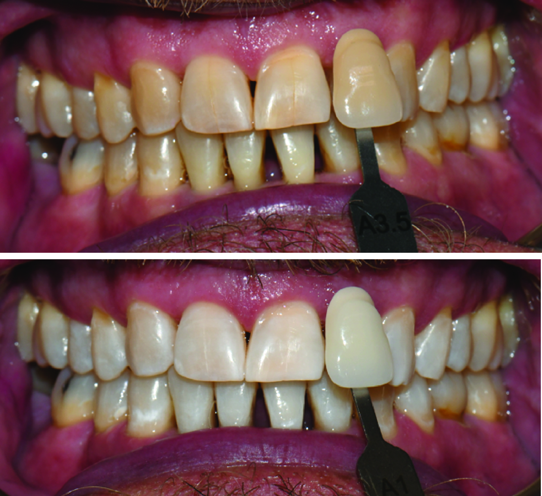 Before-and-after clinical photographs for anonymous case ZW-04.