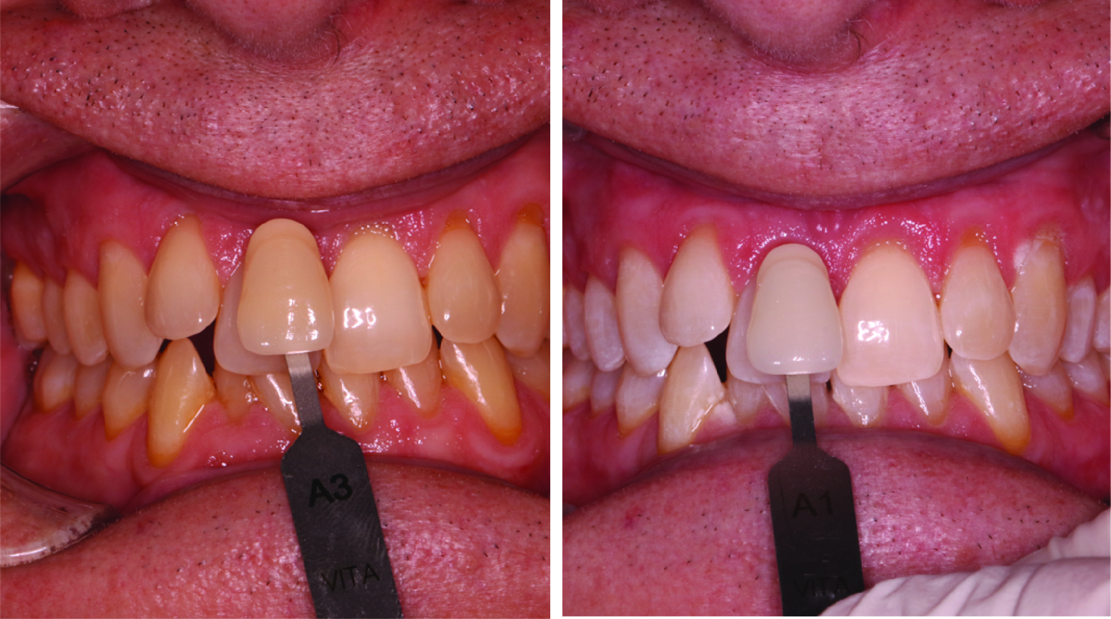 Before-and-after clinical photographs for anonymous case ZW-05.