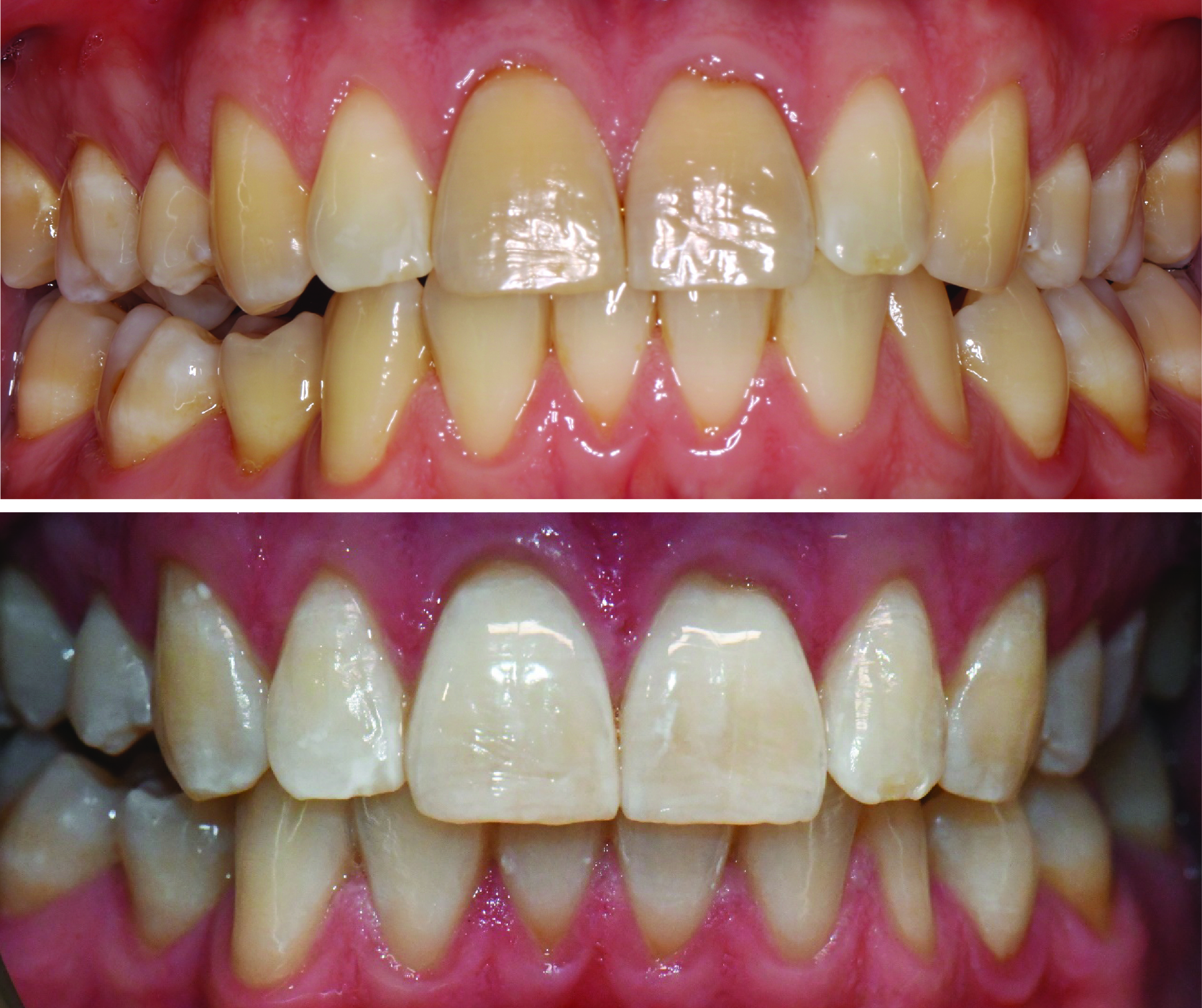 Before-and-after clinical photographs for anonymous case ZW-07.