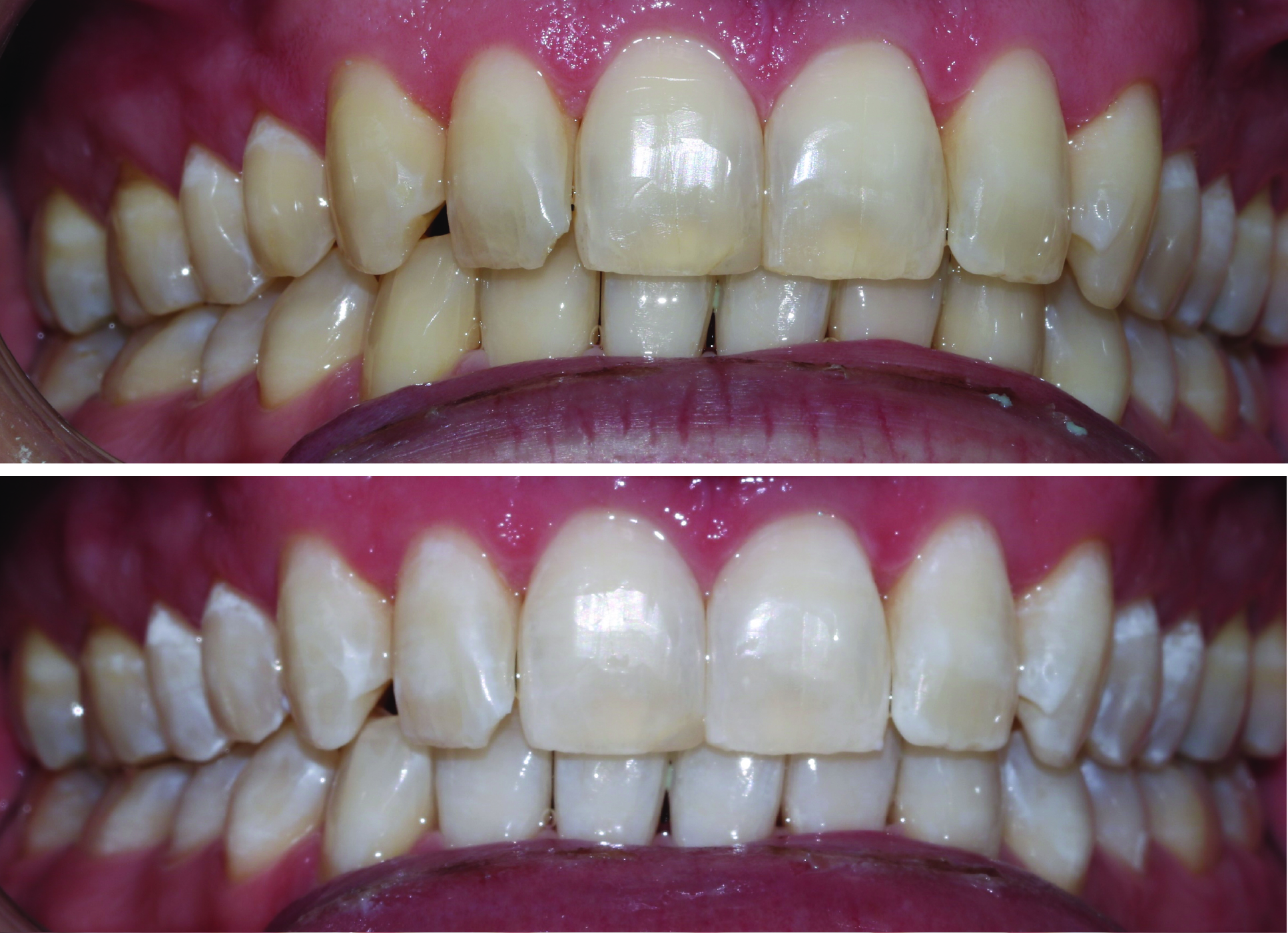 Before-and-after clinical photographs for anonymous case ZW-08.