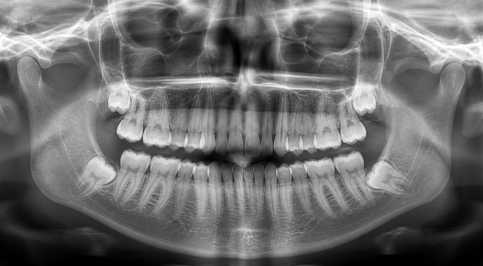 Educational panoramic dental X-ray-style illustration showing impacted lower wisdom teeth